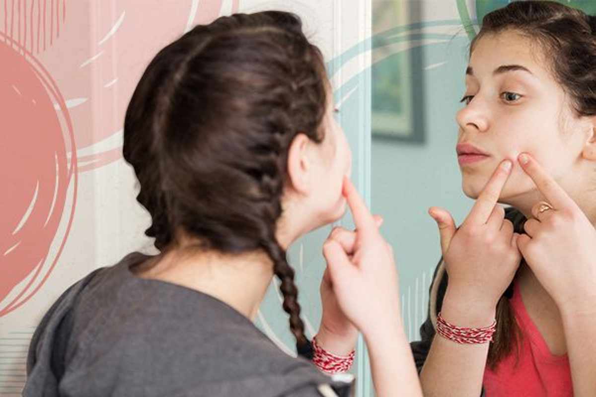 Teenage Acne (Pimples): 5 Tips on How to Manage Teen Acne
