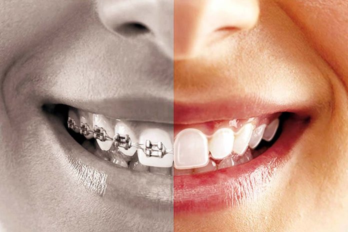 Dental Braces Can Change Your Life for the Better