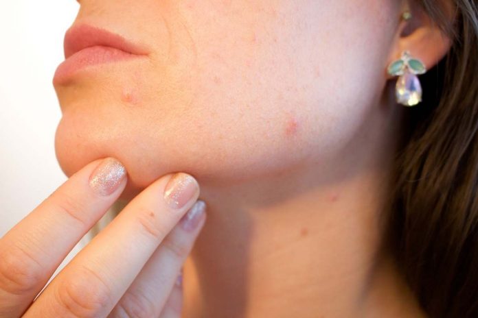 Acne : Causes & Treatment