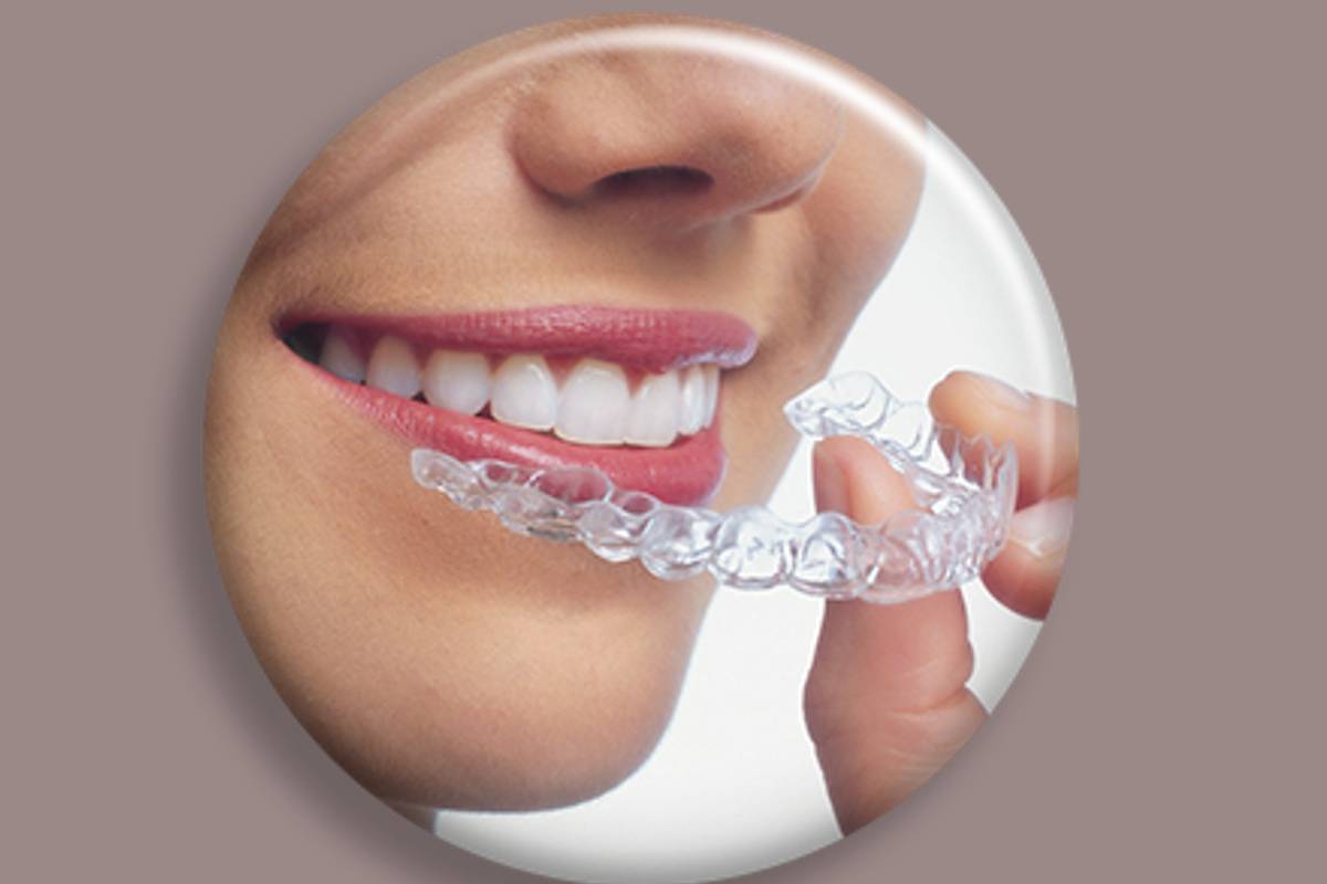 Reasons Why You Should Use Invisible Braces
