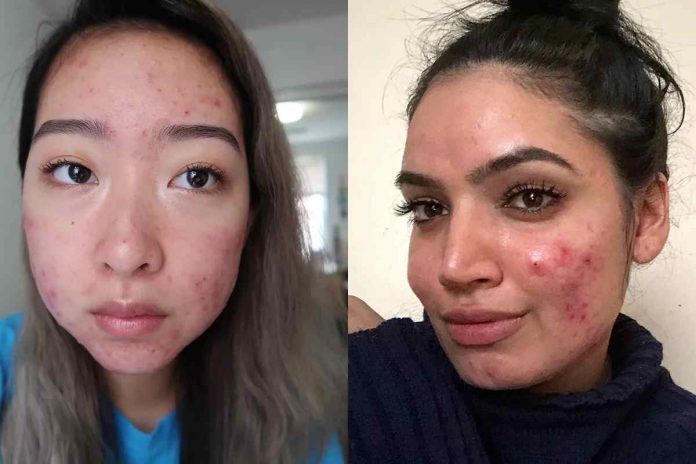 Acne Care: Don’t Let Acne Ruin Your Love Life