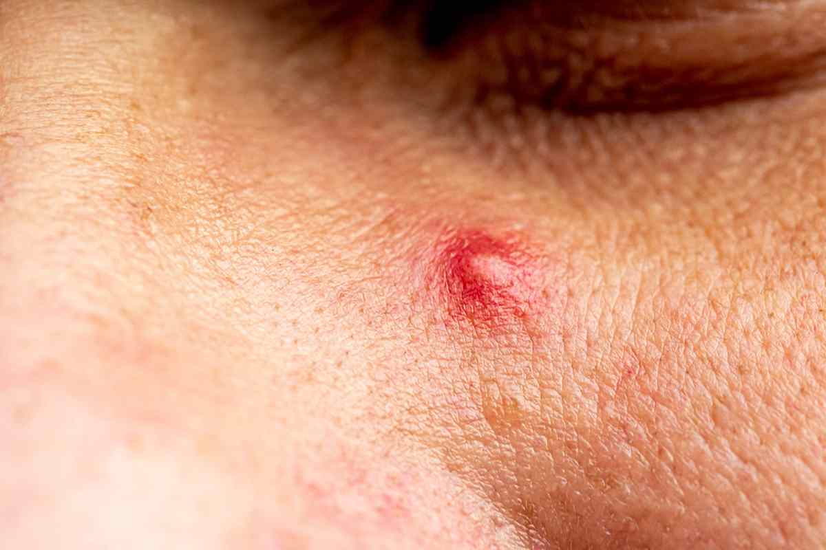 What You Can Do About a Pimple Before a Big Date