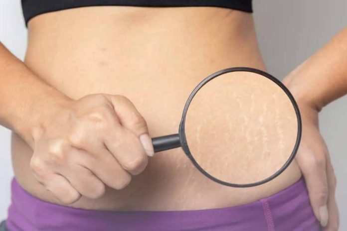 4 Common Causes of Stretch Marks