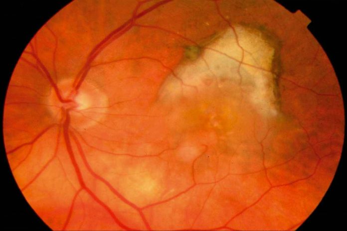 Macular Degeneration Causes and Treatment
