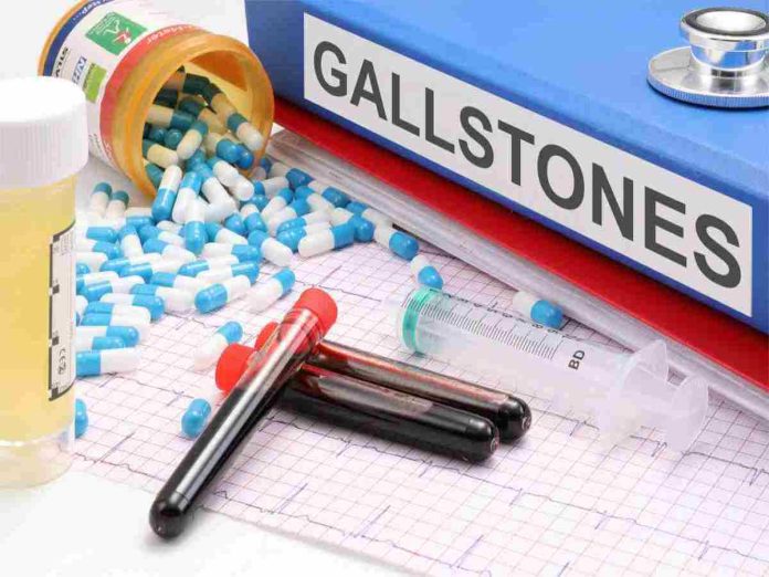 Treatment And Causes Of Gallstones