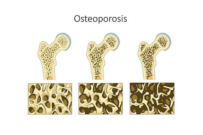 Osteoporosis- Symptoms and Treatment